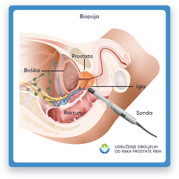 Prikazana je ilustracija koja prikazuje biopsiju prostate, s fokusom na sondu igle i područje
         muškog tijela gdje se nalazi prostata. Igličasta sonda je prikazana kao tanak, izdužen instrument
         koji se ubacuje u prostatu kako bi se izvukli mali uzorci tkiva za pregled. Okolna anatomija,
         uključujući mjehur i rektum, također su vidljivi na ilustraciji kako bi pružili kontekst i pomogli u razumijevanju
         položaj prostate u odnosu na druge strukture unutar muškog tijela.
         Ova ilustracija ima za cilj da pruži vizuelni prikaz postupka biopsije u obrazovne svrhe.