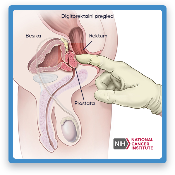 Prikazana je ilustracija koja prikazuje digitorektalni pregled, medicinski zahvat u kojem se pruža zdravstvena zaštita
         ljekar ubacuje podmazan prst u rektum kako bi osjetio bilo kakve abnormalnosti ili promjene u prostati.
         Ilustracija prikazuje pacijenta koji leži na boku sa savijenim kolenima, dok zdravstveni radnik nosi
         nosi rukavice i vrši pritisak na donji dio trbuha kako bi osjetio bilo kakve nepravilnosti. Ova ilustracija ima za cilj da pruži
         vizuelni prikaz postupka u obrazovne svrhe.