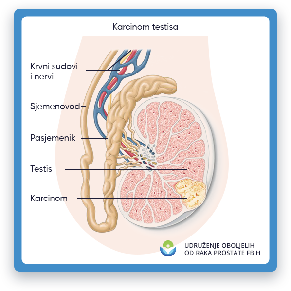Ova ilustracija prikazuje dio muškog tijela, fokusiran na testise.
                 Jedan od testisa izgleda uvećan i nepravilnog oblika, što ukazuje na prisustvo raka testisa.
                 Rak se također može proširiti na obližnje limfne čvorove u području prepona. Rak testisa je vrsta raka koja se razvija
                 u testisima, koji su dio muškog reproduktivnog sistema. To je relativno rijedak oblik raka,
                 ali rano otkrivanje i liječenje su kritični za uspješan ishod.