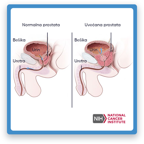 Prikazana je ilustracija koja upoređuje normalnu prostatu sa uvećanom prostatom.
         Normalna prostata izgleda mala i kompaktna, dok se uvećana prostata čini znatno većom
         i opstruira mokraćnu cijev, što dovodi do potencijalnih problema s mokrenjem kao što su otežano mokrenje ili učestalo mokrenje.
         Ova ilustracija ima za cilj da istakne razlike u veličini i obliku između zdrave prostate i one koja ima
         pretrpeo proširenje.
