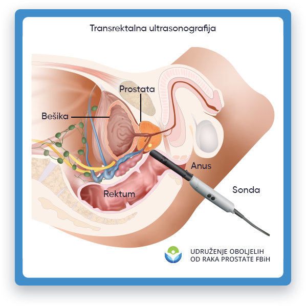 Prikazana je ilustracija koja prikazuje transrektalnu ultrazvučnu proceduru,
         sa fokusom na sondu igle, muško tijelo gdje se nalazi prostata,
         i pacijent koji leži u krevetu dok doktor obavlja pregled. Sonda igle je prikazana kao tanka,
         izduženi instrument koji se ubacuje u rektum kako bi proizveo zvučne valove visoke frekvencije koji se odbijaju od
         prostate i stvaraju sliku na monitoru. Okolna anatomija, uključujući bešiku i rektum, je takođe
         vidljivo na ilustraciji kako bi pružio kontekst i pomogao u razumijevanju lokacije prostate u odnosu
         na druge strukture unutar muškog tijela. Ova ilustracija ima za cilj da pruži vizuelni prikaz transrektala
         ultrazvučni postupak u edukativne svrhe.